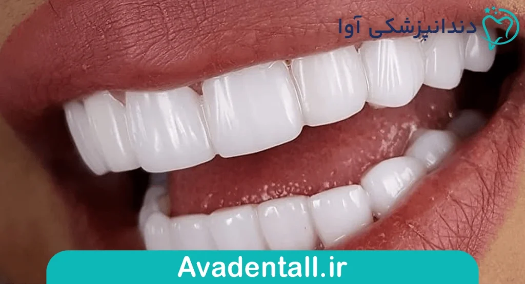 کامپوزیت به رنگ سفید