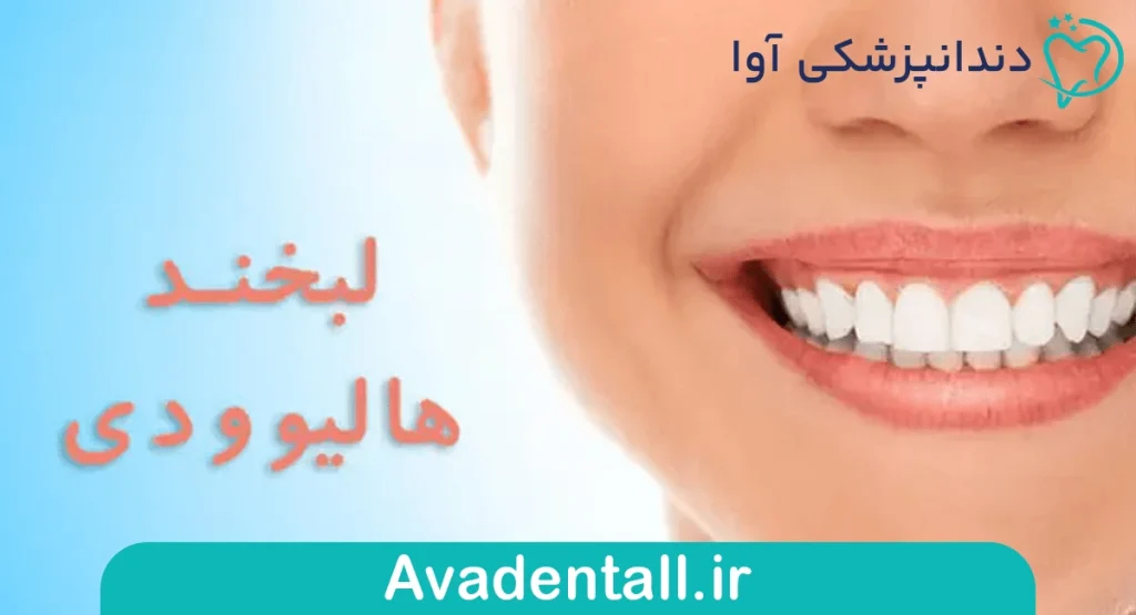 لبخند هالیوودی