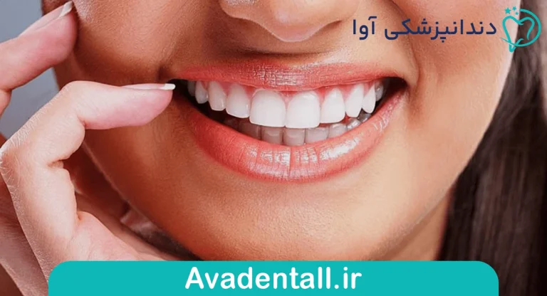 لبخند هالیوودی
