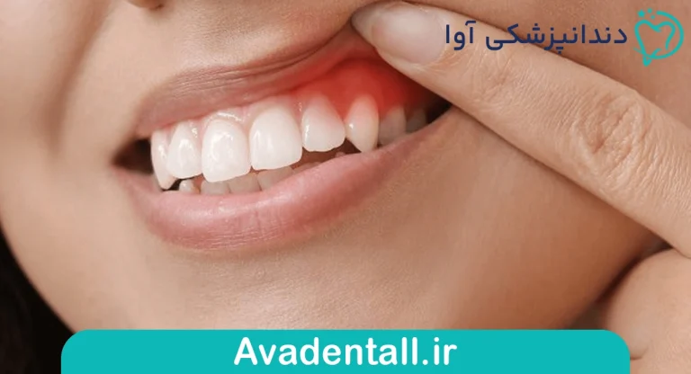 عفونت لثه