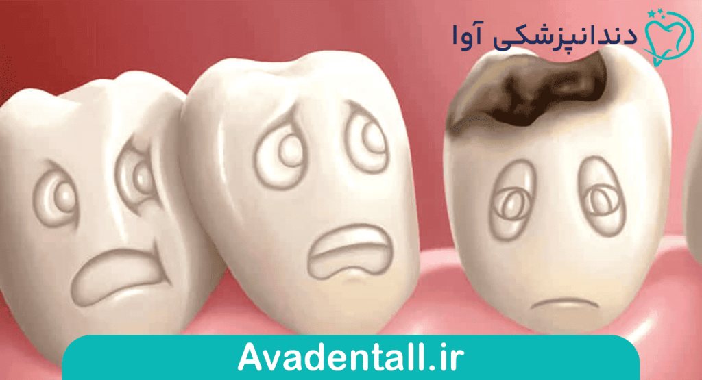لمینت دندان