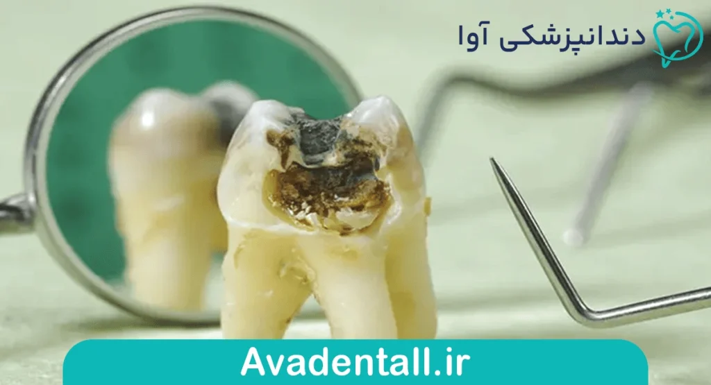 پرکردن دندان
