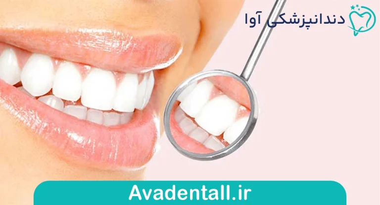 تفاوت لمینت و کامپوزیت