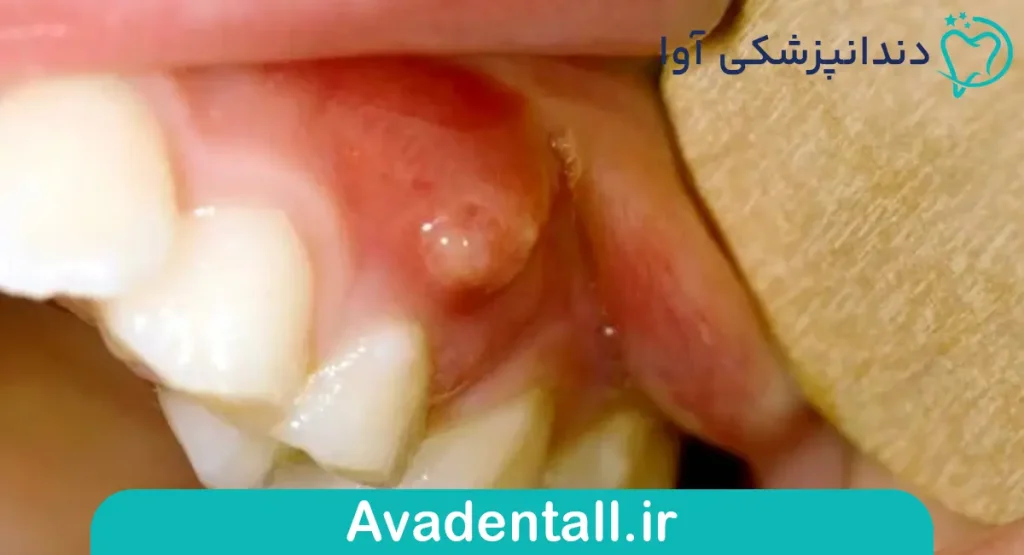 جوش روی لثه