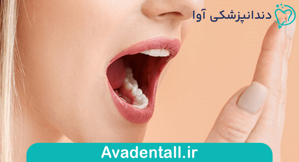 بوی بد دهان