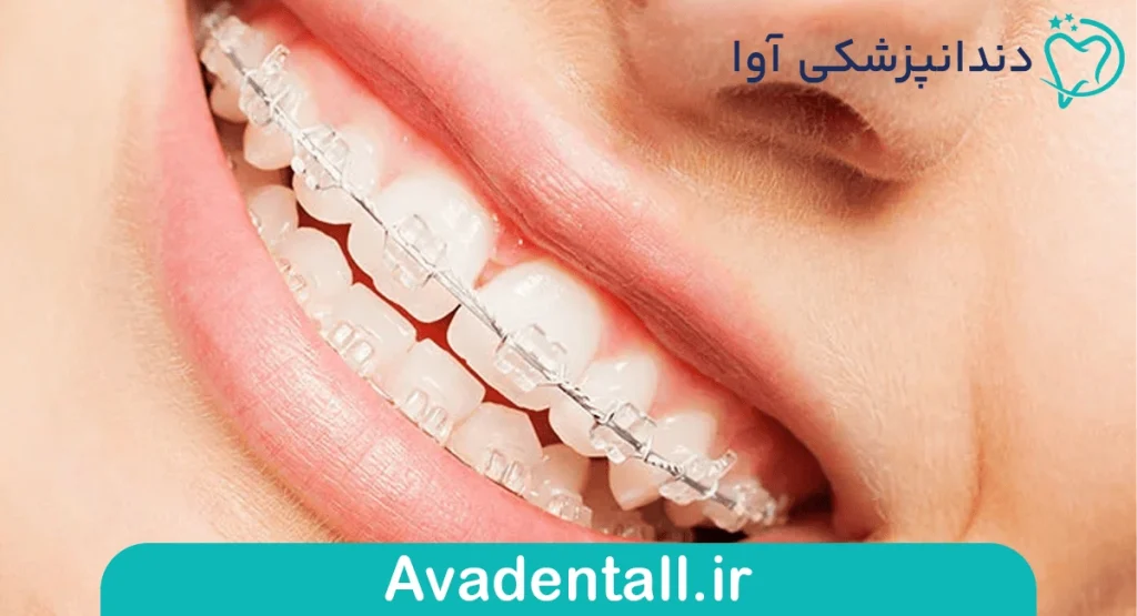 ارتودنسی سرامیکی