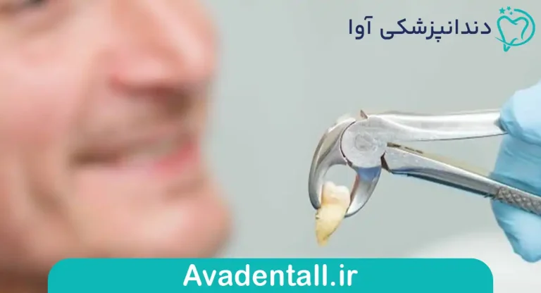علت کشیدن دندان