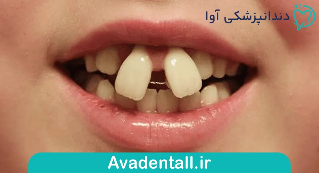 کامپوزیت دندان خرگوشی