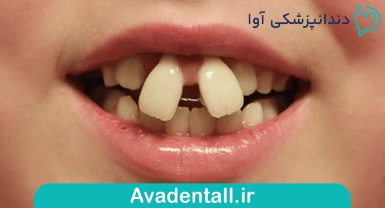 کامپوزیت دندان خرگوشی