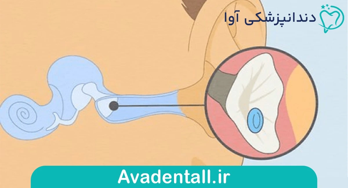 جابه جایی ذرات کریستالی گوش