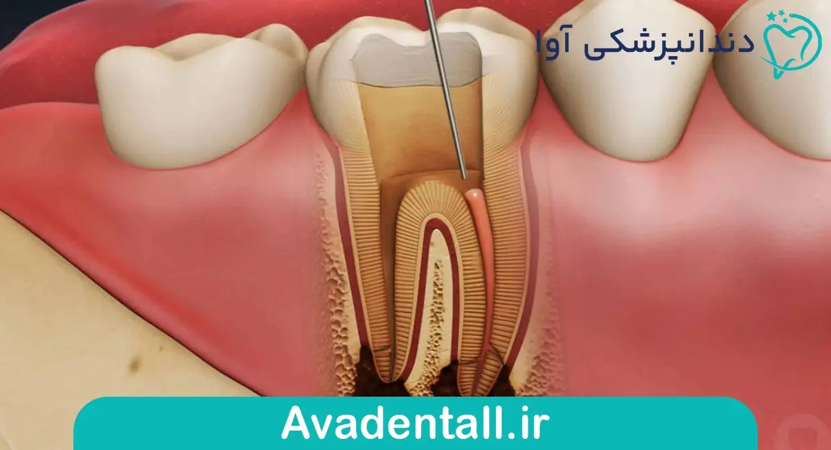 التهاب و عفونت ریشه دندان