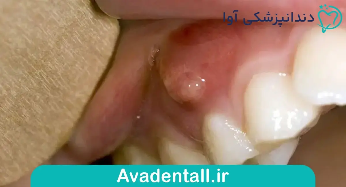بیماری لثه ای بر اثر سیگار