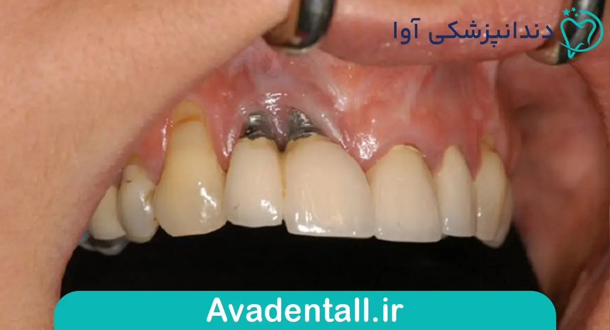 تاثیرات منفی سیگار بر درمان های دندانپزشکی
