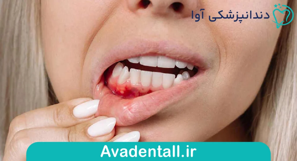 چرا لثه‌ها خونریزی می‌کنند؟