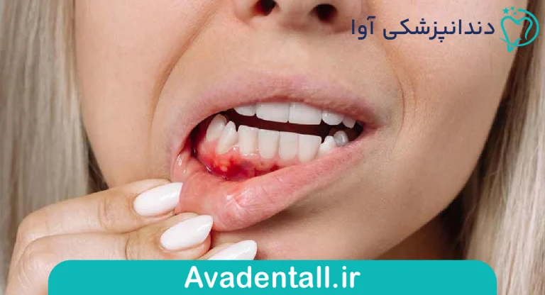 چرا لثه‌ها خونریزی می‌کنند؟