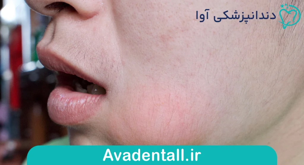 علائم و نشانه‌های عفونت دندان بعد از عصب کشی