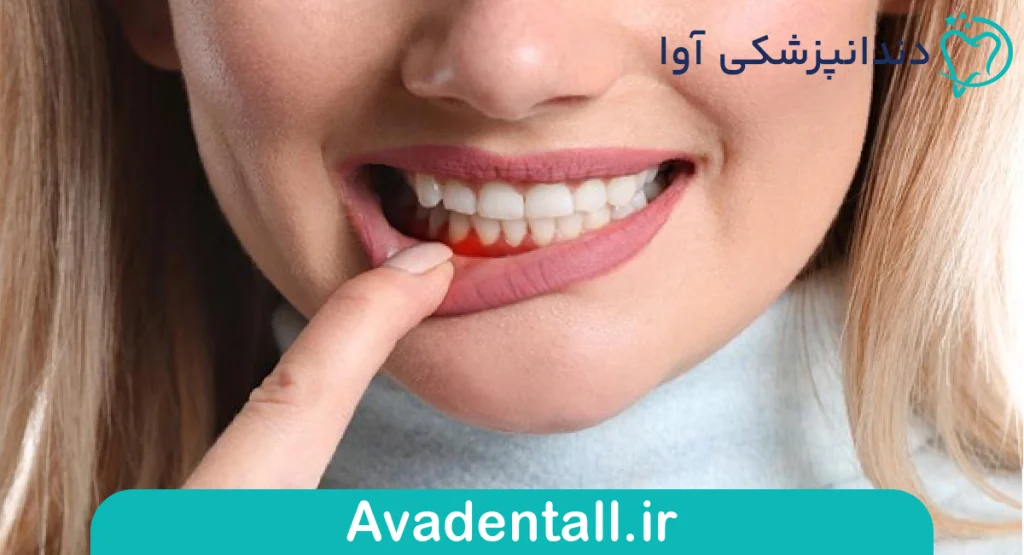 پیشگیری از خونریزی لثه