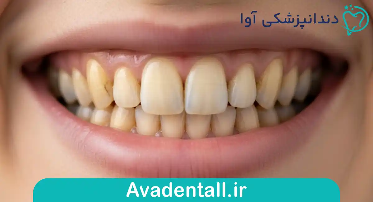 تغییر رنگ دادان ها
