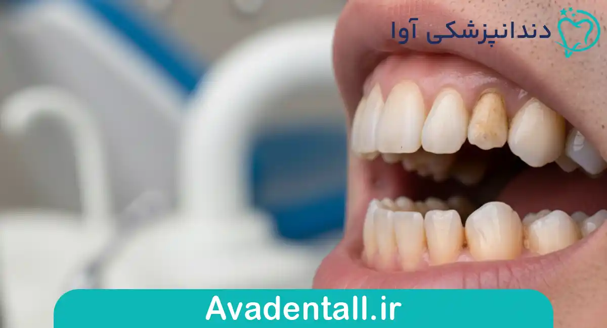 پوسیدگی‌های عمیق که به عصب دندان رسیده‌اند