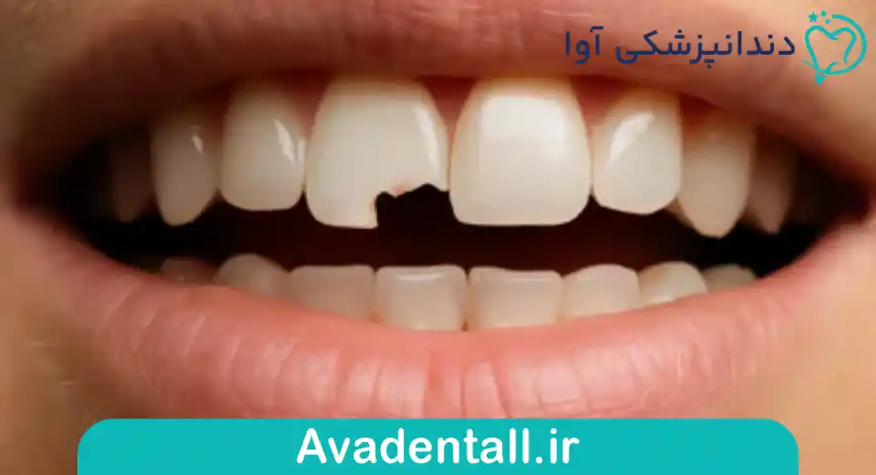 لب‌پر شدن دندان‌های جلویی