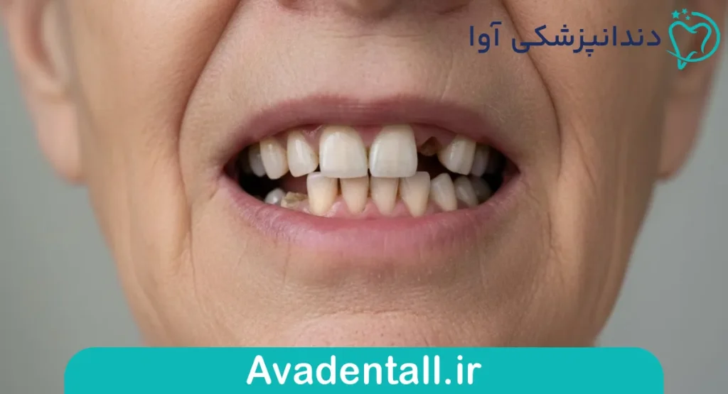 بی‌دندانی تک دندانی یا چند دندانی