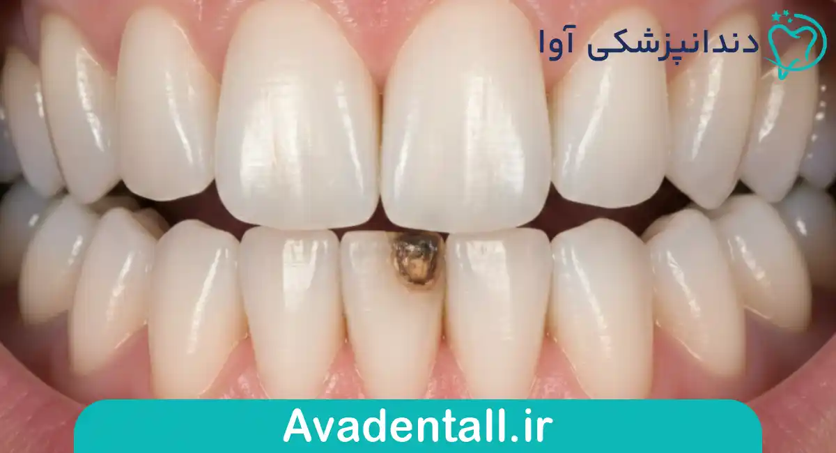 پوسیدگی‌های عمیق که به عصب دندان رسیده‌اند