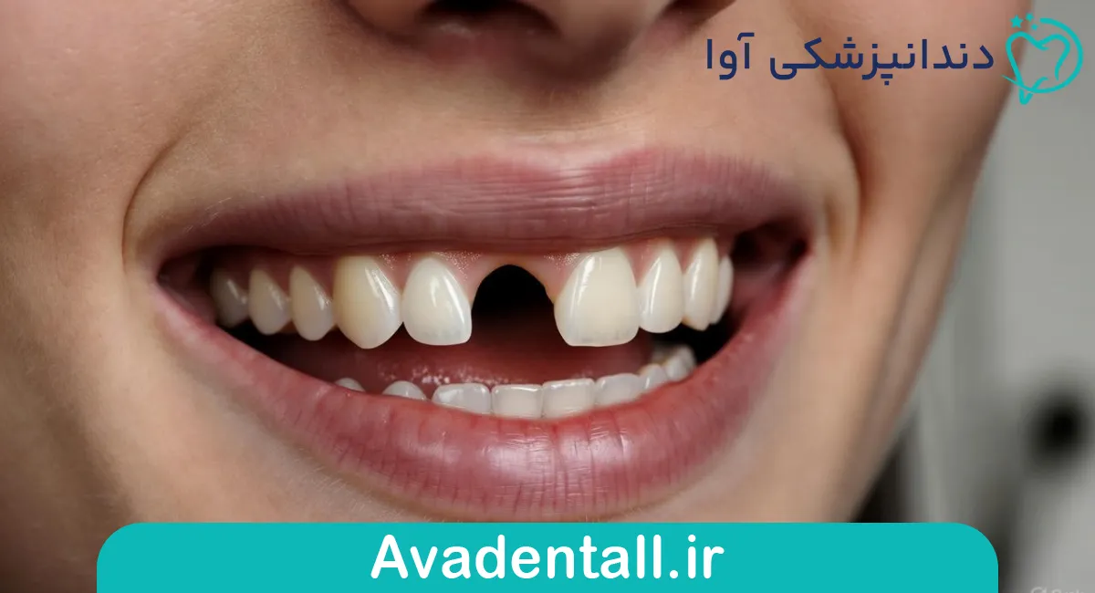 بی‌دندانی تک دندانی یا چند دندانی