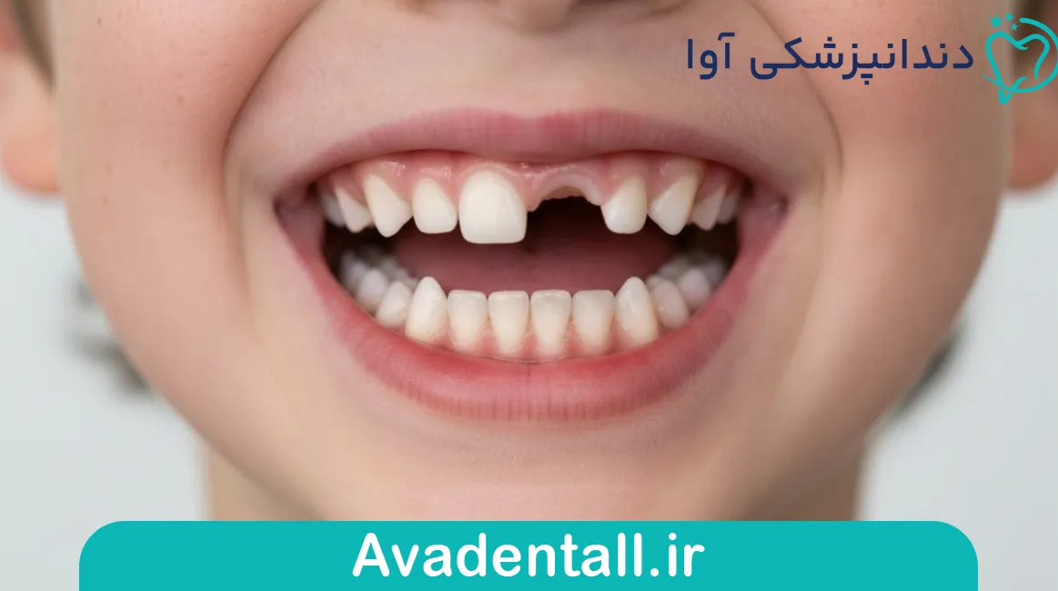  بی‌دندانی تک دندانی یا چند دندانی