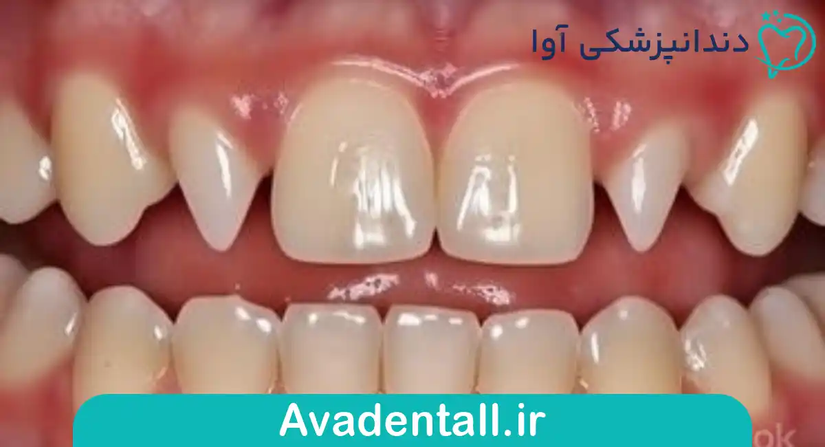 دندان‌های میخ‌شکل (Peg Lateral Incisors)