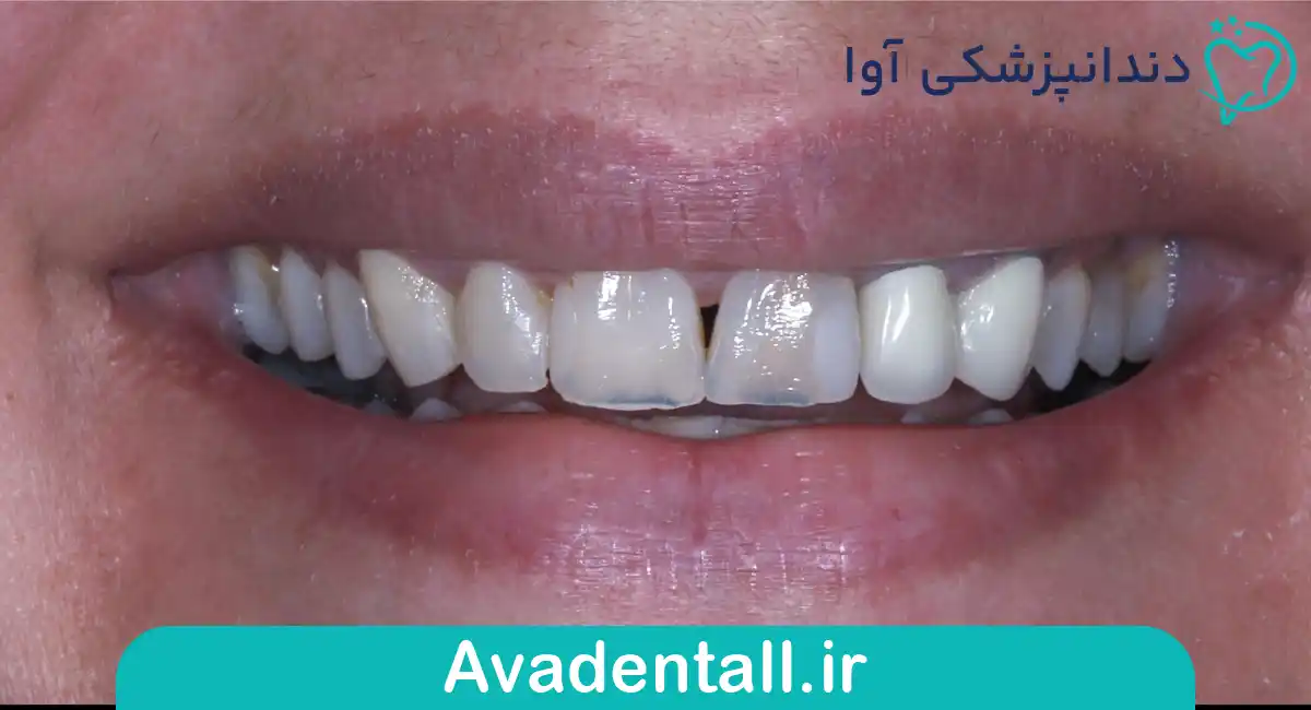 تغییر رنگ‌های مقاوم به بلیچینگ