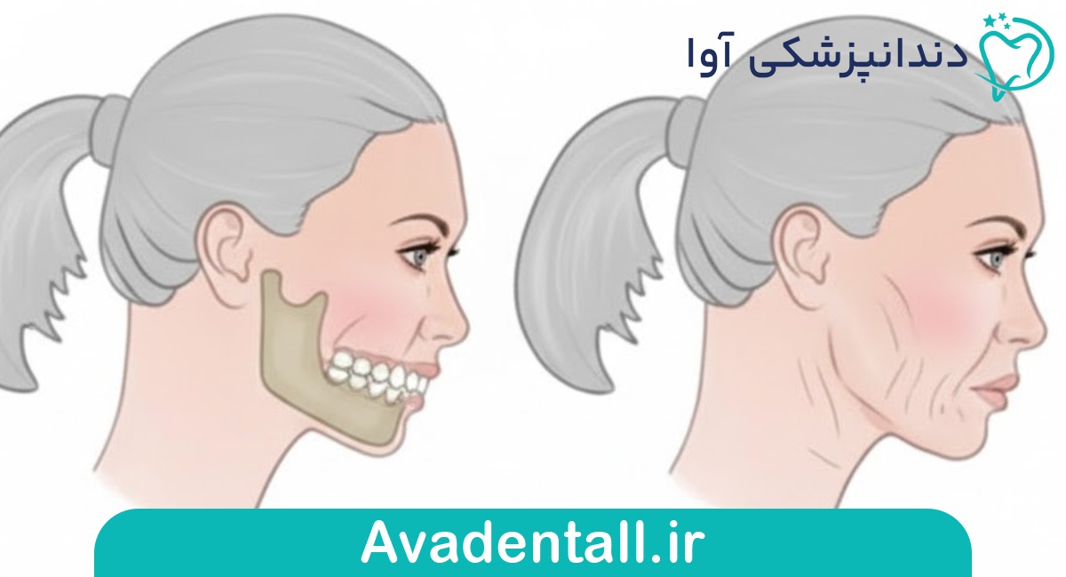 تحلیل استخوان فک