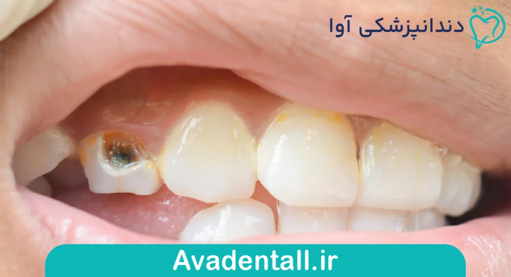  علائم هشداردهنده پوسیدگی دندان جلو