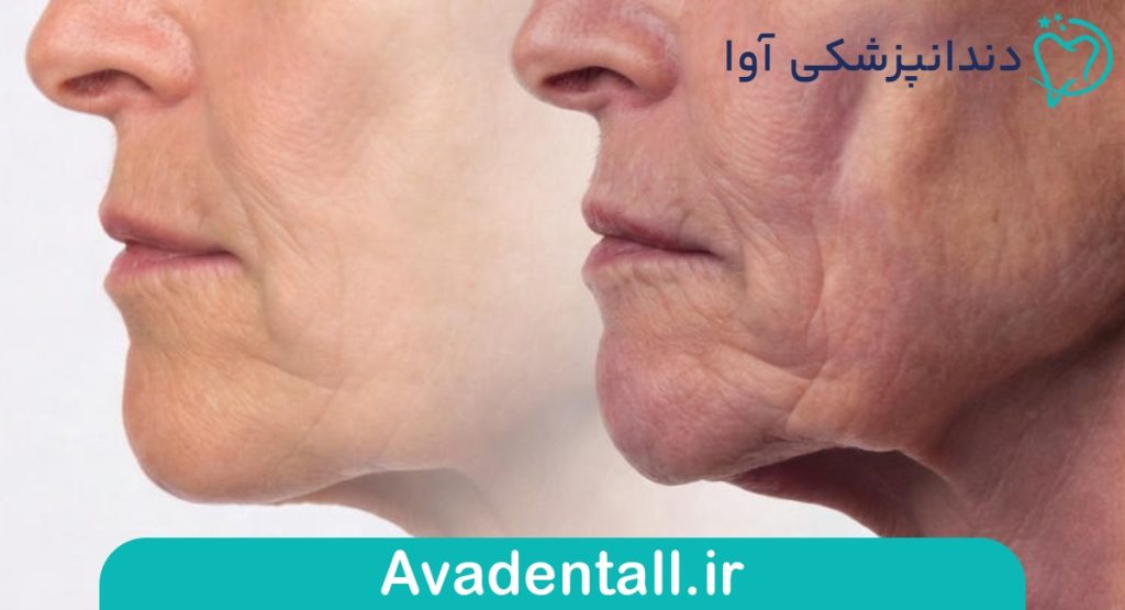 تحلیل استخوان فک