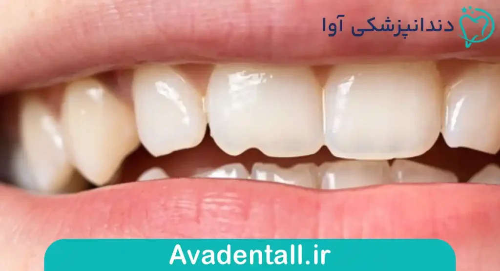 لب‌پر شدن دندان‌های جلویی